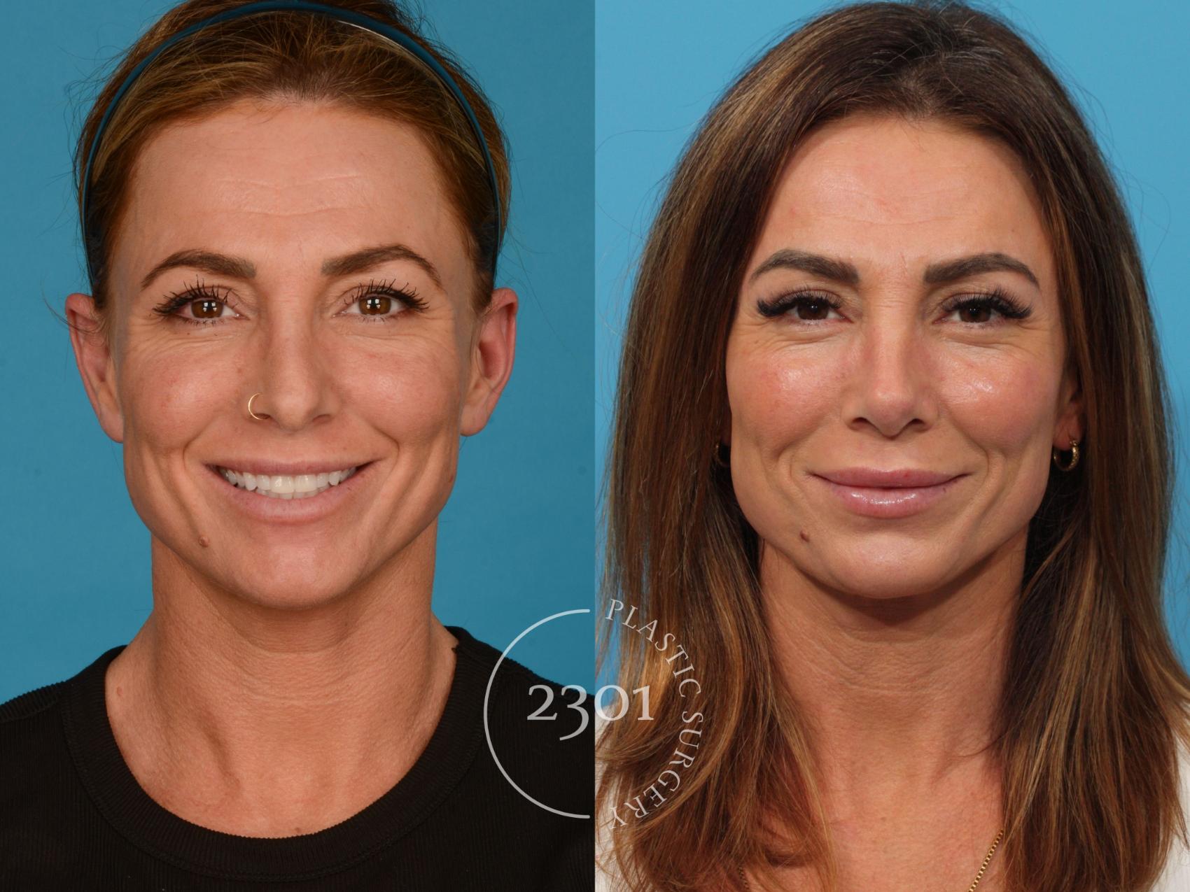 Before & After Brow Lift Case 737 Front View in Fort Worth, Plano, & Frisco, Texas