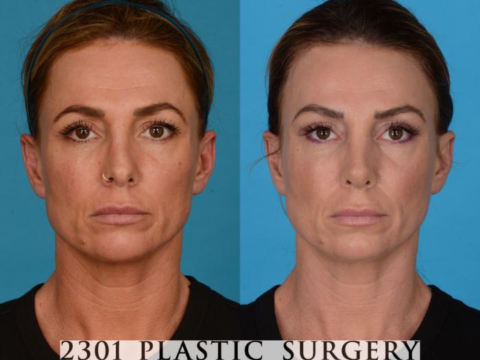Before & After Rhinoplasty Case 737 Front View in Fort Worth, Plano, & Frisco, Texas