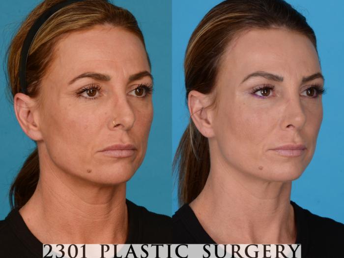 Before & After Blepharoplasty Case 737 Right Oblique View in Fort Worth, Plano, & Frisco, Texas