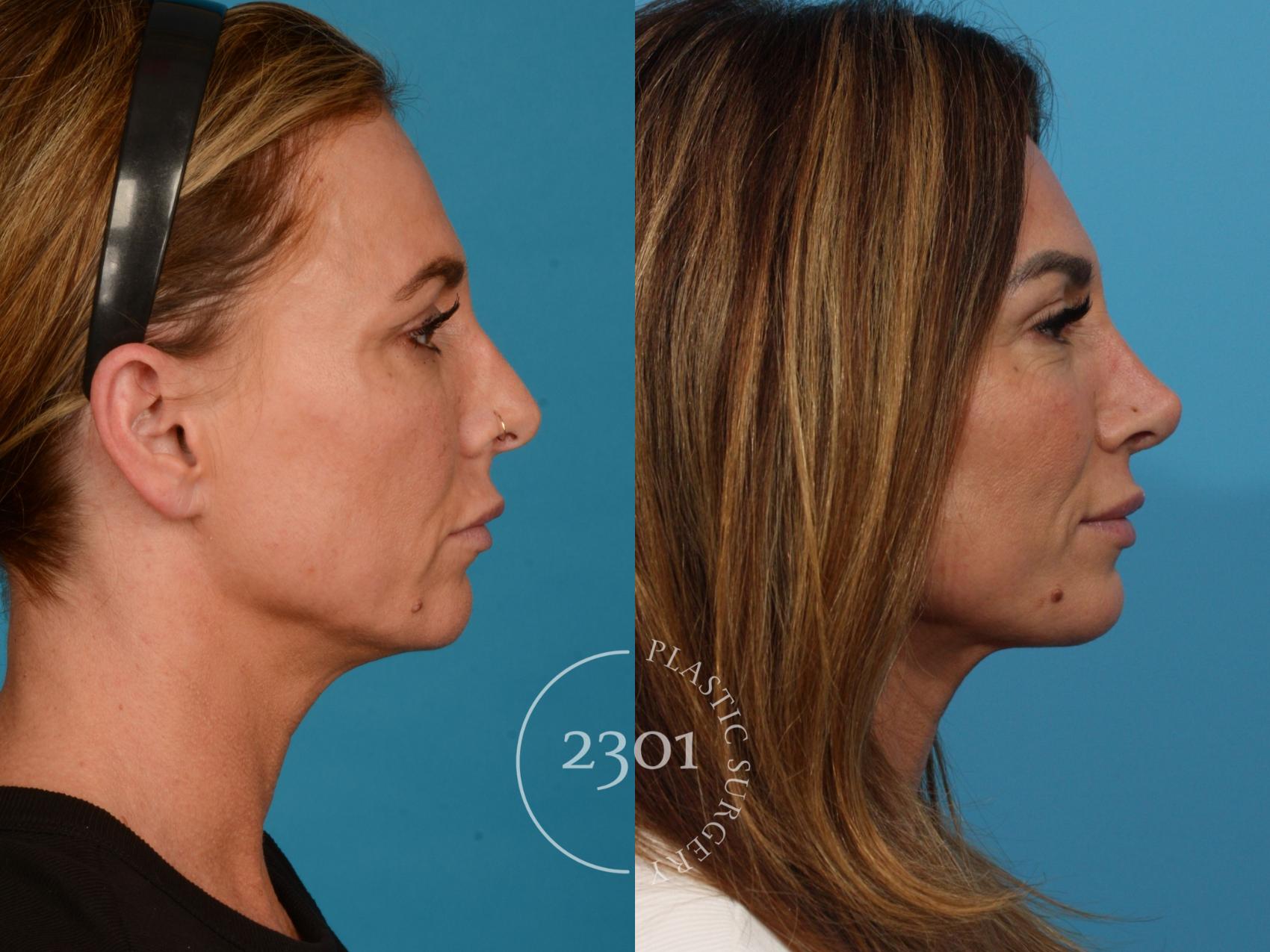 Before & After Rhinoplasty Case 737 Right Side View in Fort Worth, Plano, & Frisco, Texas