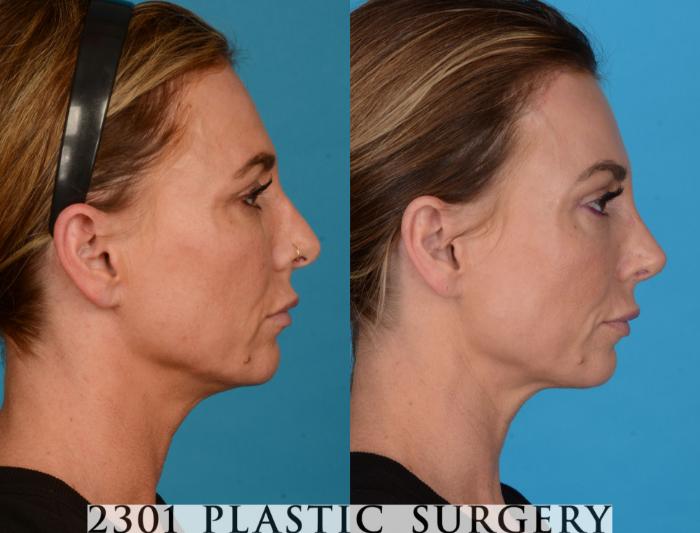 Before & After Blepharoplasty Case 737 Right Side View in Fort Worth, Plano, & Frisco, Texas