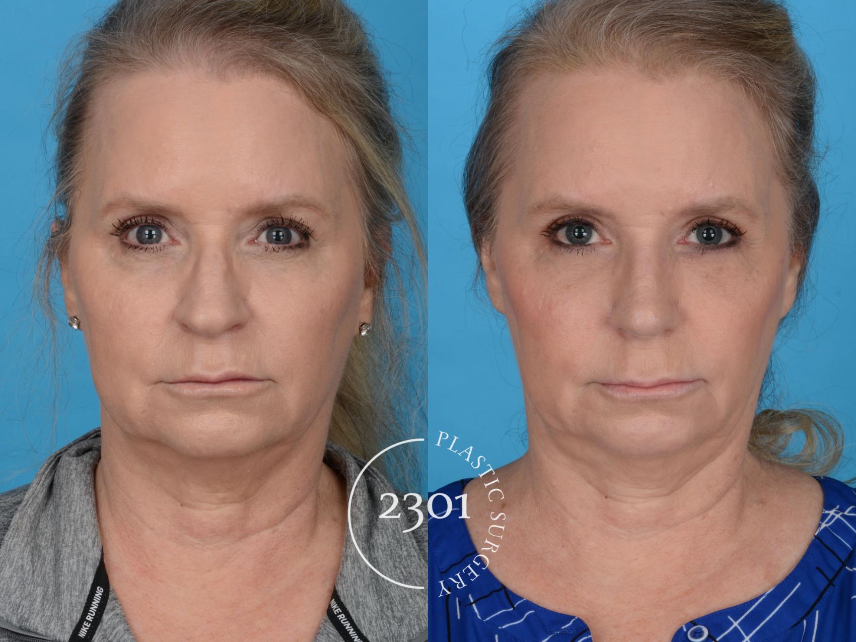 Before & After Blepharoplasty Case 759 Front View in Fort Worth, Plano, & Frisco, Texas