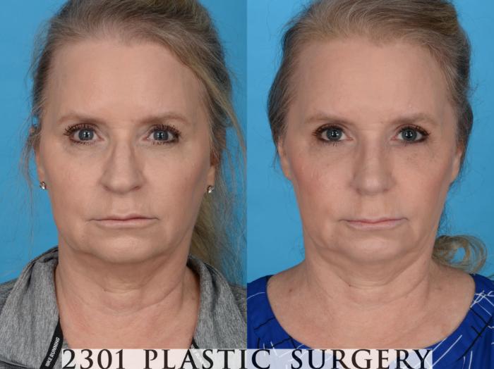Before & After Blepharoplasty Case 759 Front View in Fort Worth & Frisco, Texas