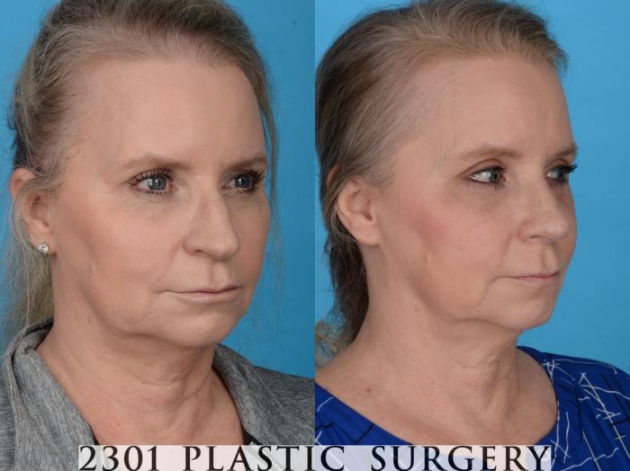 Before & After Blepharoplasty Case 759 Right Oblique View in Fort Worth, Plano, & Frisco, Texas