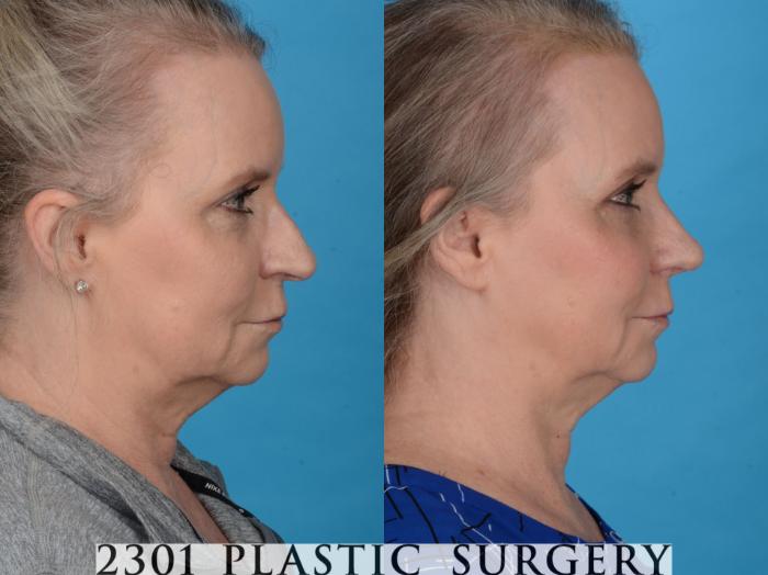 Before & After Blepharoplasty Case 759 Right Side View in Fort Worth, Plano, & Frisco, Texas