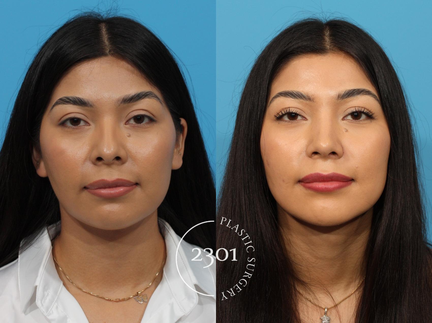 Before & After Rhinoplasty Case 766 Front View in Fort Worth, Plano, & Frisco, Texas