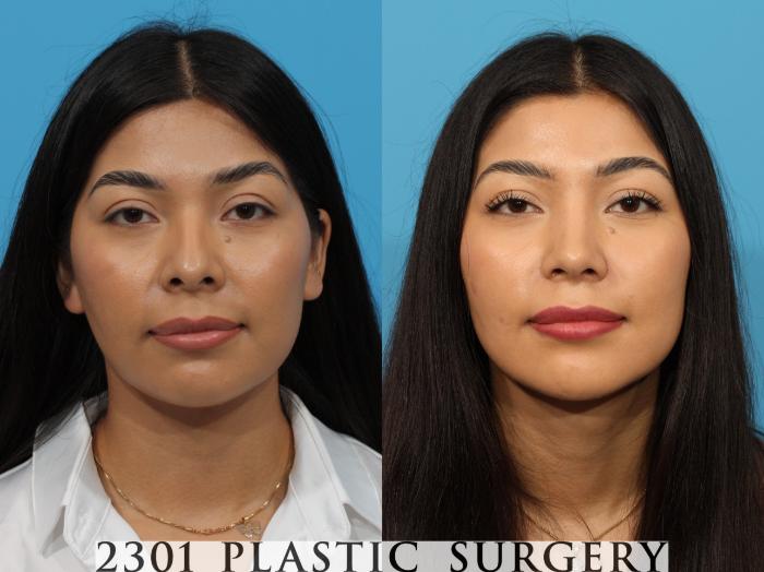 Before & After Rhinoplasty Case 766 Front View in Fort Worth, Plano, & Frisco, Texas