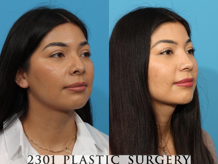 Before & After Rhinoplasty Case 766 Right Oblique View in Fort Worth, Plano, & Frisco, Texas