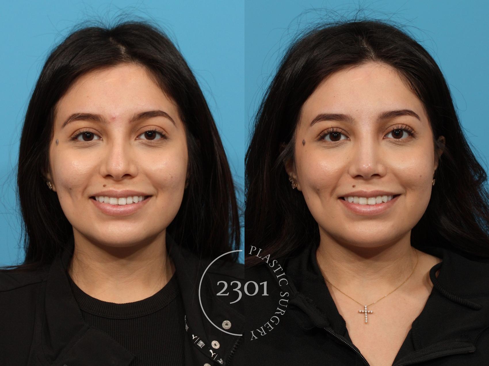 Before & After Rhinoplasty Case 772 Front View in Fort Worth, Plano, & Frisco, Texas