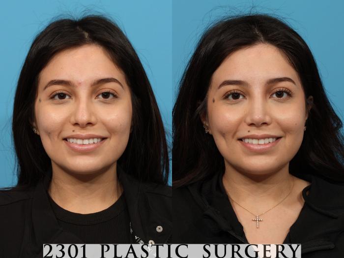 Before & After Rhinoplasty Case 772 Front View in Fort Worth, Plano, & Frisco, Texas