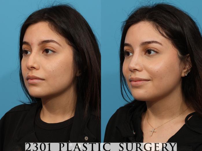 Before & After Rhinoplasty Case 772 Left Oblique View in Fort Worth, Plano, & Frisco, Texas