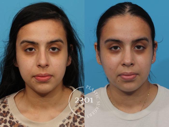 Before & After Rhinoplasty Case 805 Front View in Fort Worth, Plano, & Frisco, Texas