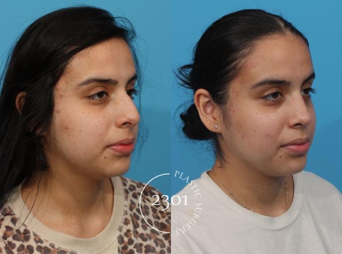 Before & After Rhinoplasty Case 805 Right Oblique View in Fort Worth, Plano, & Frisco, Texas