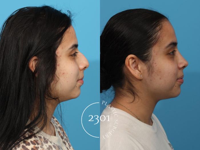 Before & After Rhinoplasty Case 805 Right Side View in Fort Worth, Plano, & Frisco, Texas