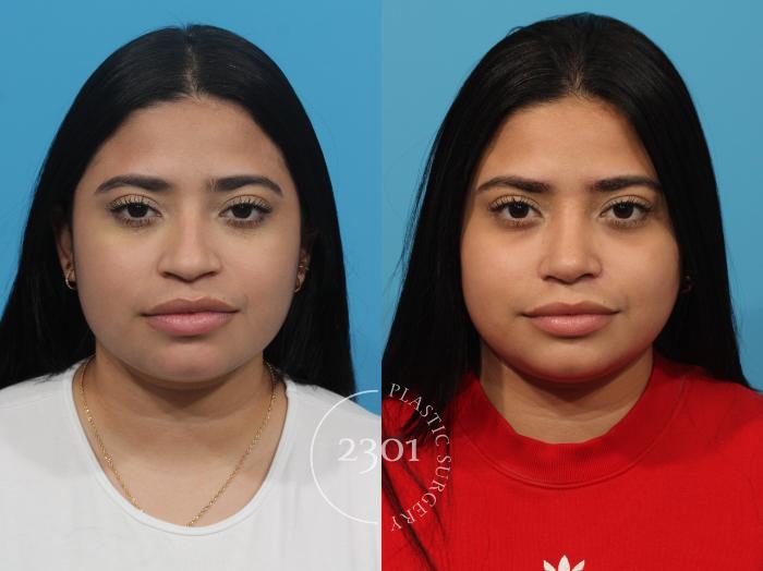 Before & After Rhinoplasty Case 813 Front View in Fort Worth, Plano, & Frisco, Texas