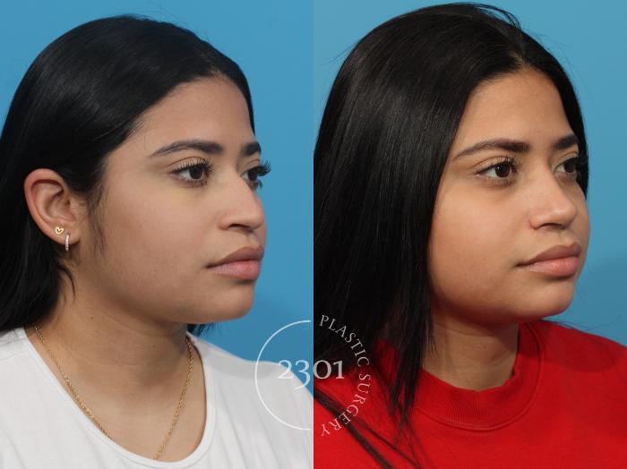 Before & After Rhinoplasty Case 813 Right Oblique View in Fort Worth, Plano, & Frisco, Texas