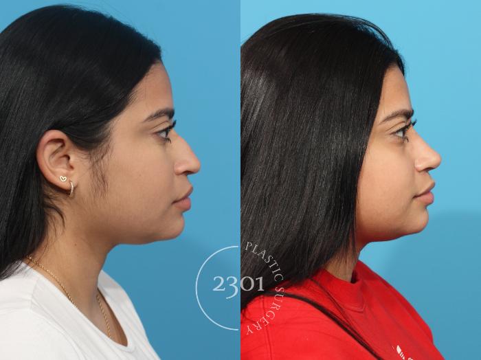 Before & After Rhinoplasty Case 813 Right Side View in Fort Worth, Plano, & Frisco, Texas