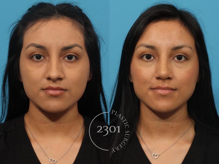 Before & After Rhinoplasty Case 814 Front View in Fort Worth, Plano, & Frisco, Texas