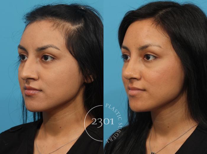 Before & After Rhinoplasty Case 814 Left Oblique View in Fort Worth, Plano, & Frisco, Texas