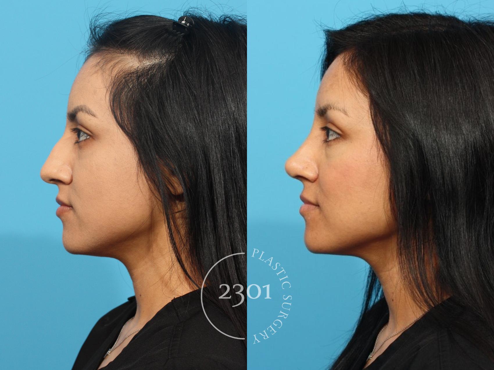 Before & After Rhinoplasty Case 814 Left Side View in Fort Worth, Plano, & Frisco, Texas