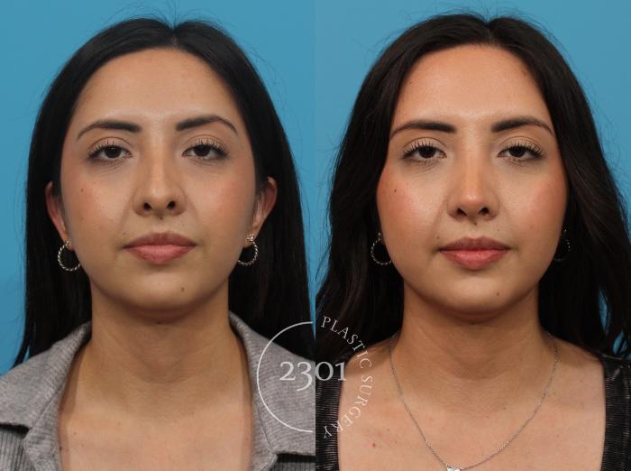 Before & After Rhinoplasty Case 821 Front View in Fort Worth, Plano, & Frisco, Texas