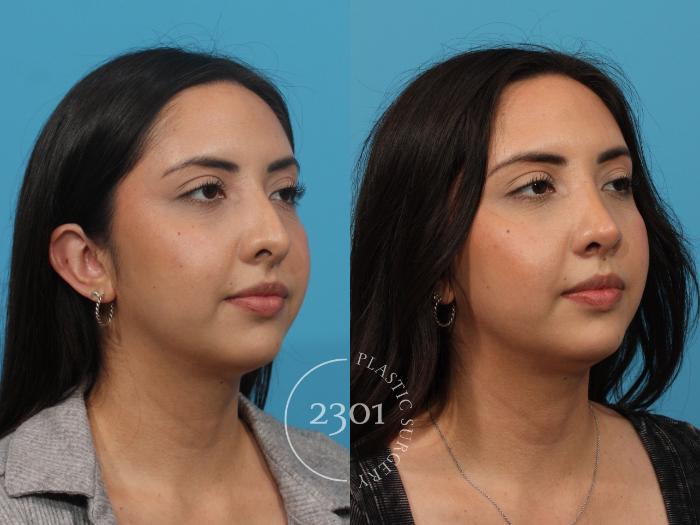 Before & After Rhinoplasty Case 821 Right Oblique View in Fort Worth, Plano, & Frisco, Texas