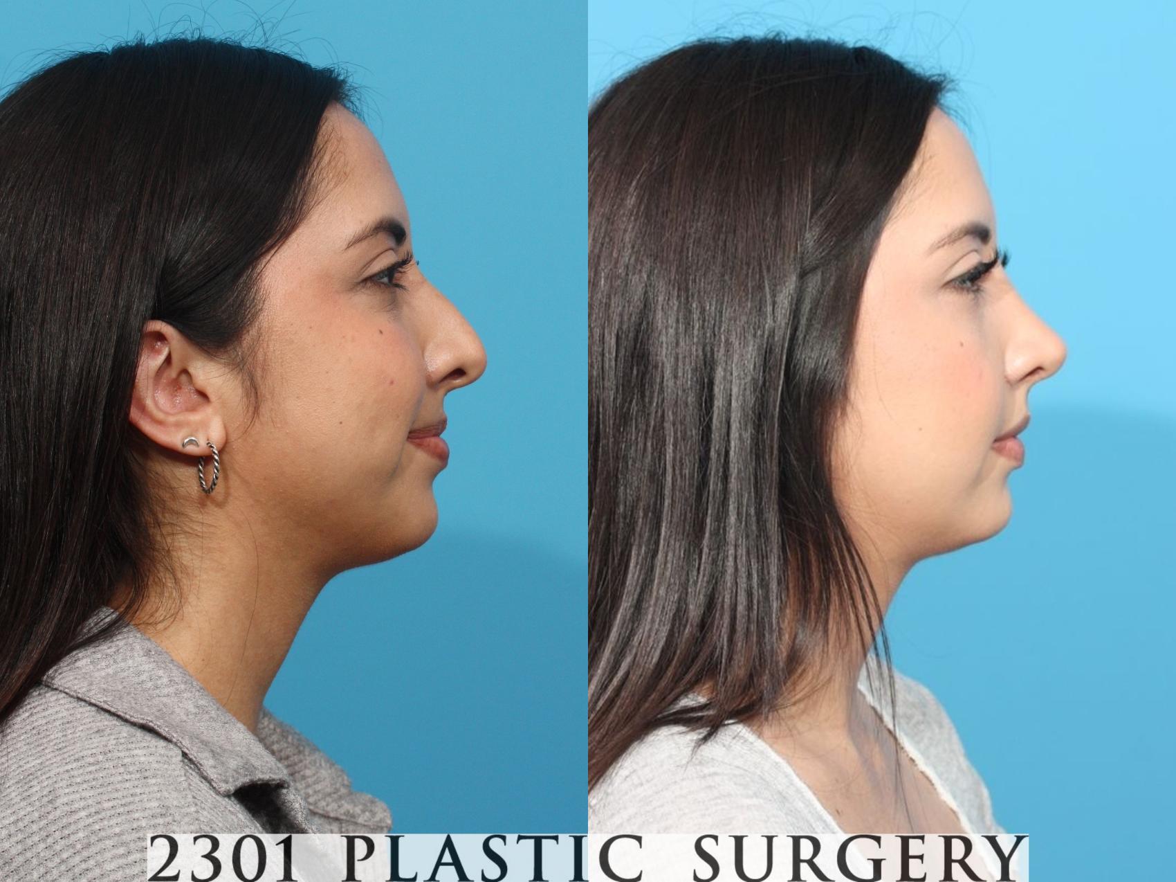 Before & After Rhinoplasty Case 821 Right Side View in Fort Worth, Plano, & Frisco, Texas