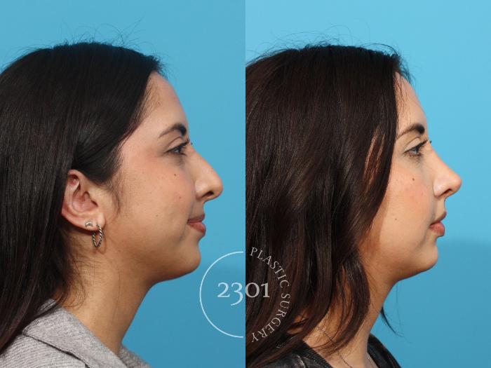 Before & After Rhinoplasty Case 821 Right Side View in Fort Worth, Plano, & Frisco, Texas