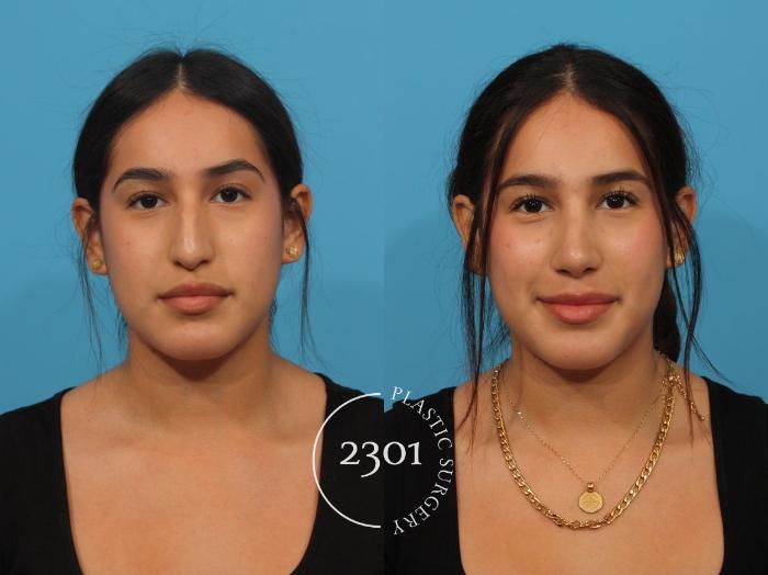 Before & After Rhinoplasty Case 825 Front View in Fort Worth, Plano, & Frisco, Texas