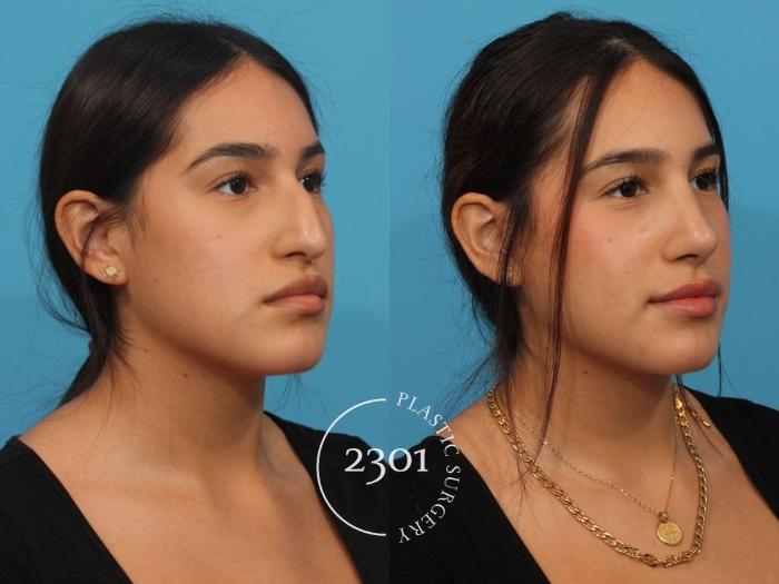 Before & After Rhinoplasty Case 825 Right Oblique View in Fort Worth, Plano, & Frisco, Texas