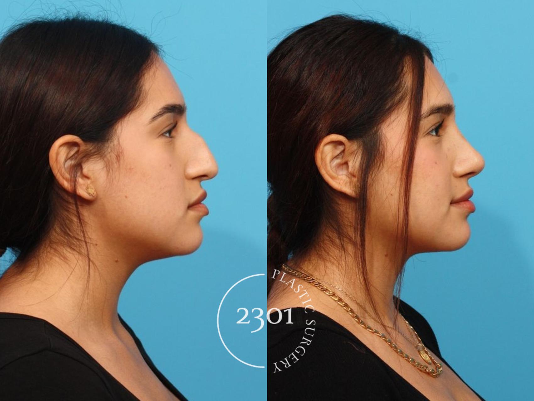 Before & After Rhinoplasty Case 825 Right Side View in Fort Worth, Plano, & Frisco, Texas