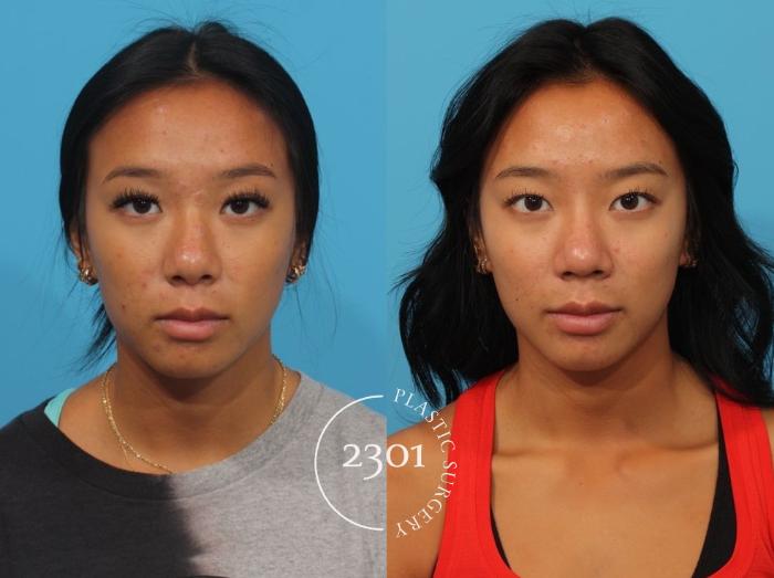 Before & After Rhinoplasty Case 826 Front View in Fort Worth, Plano, & Frisco, Texas