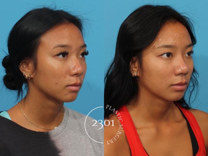 Before & After Rhinoplasty Case 826 Right Oblique View in Fort Worth, Plano, & Frisco, Texas