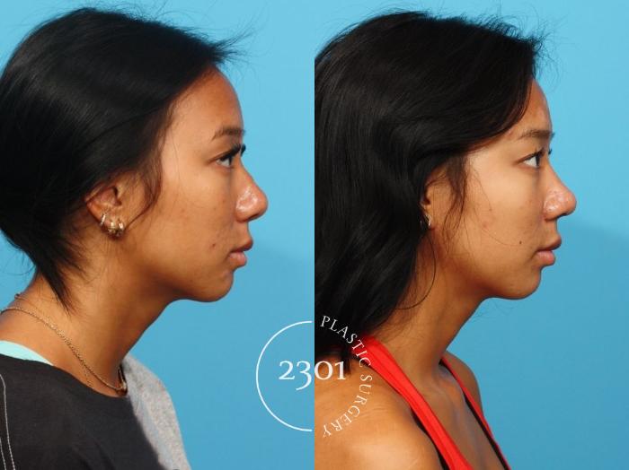 Before & After Rhinoplasty Case 826 Right Side View in Fort Worth, Plano, & Frisco, Texas