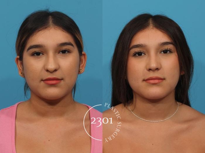 Before & After Rhinoplasty Case 827 Front View in Fort Worth, Plano, & Frisco, Texas