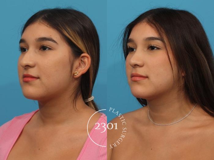 Before & After Rhinoplasty Case 827 Left Oblique View in Fort Worth, Plano, & Frisco, Texas