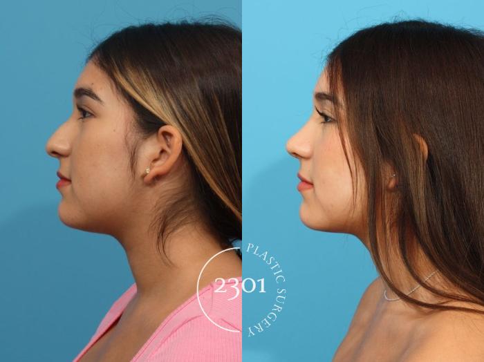 Before & After Rhinoplasty Case 827 Left Side View in Fort Worth, Plano, & Frisco, Texas