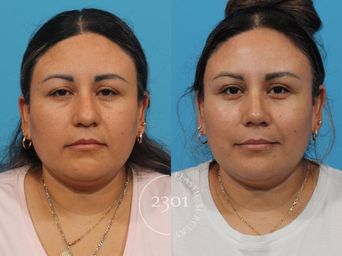 Before & After Rhinoplasty Case 829 Front View in Fort Worth, Plano, & Frisco, Texas