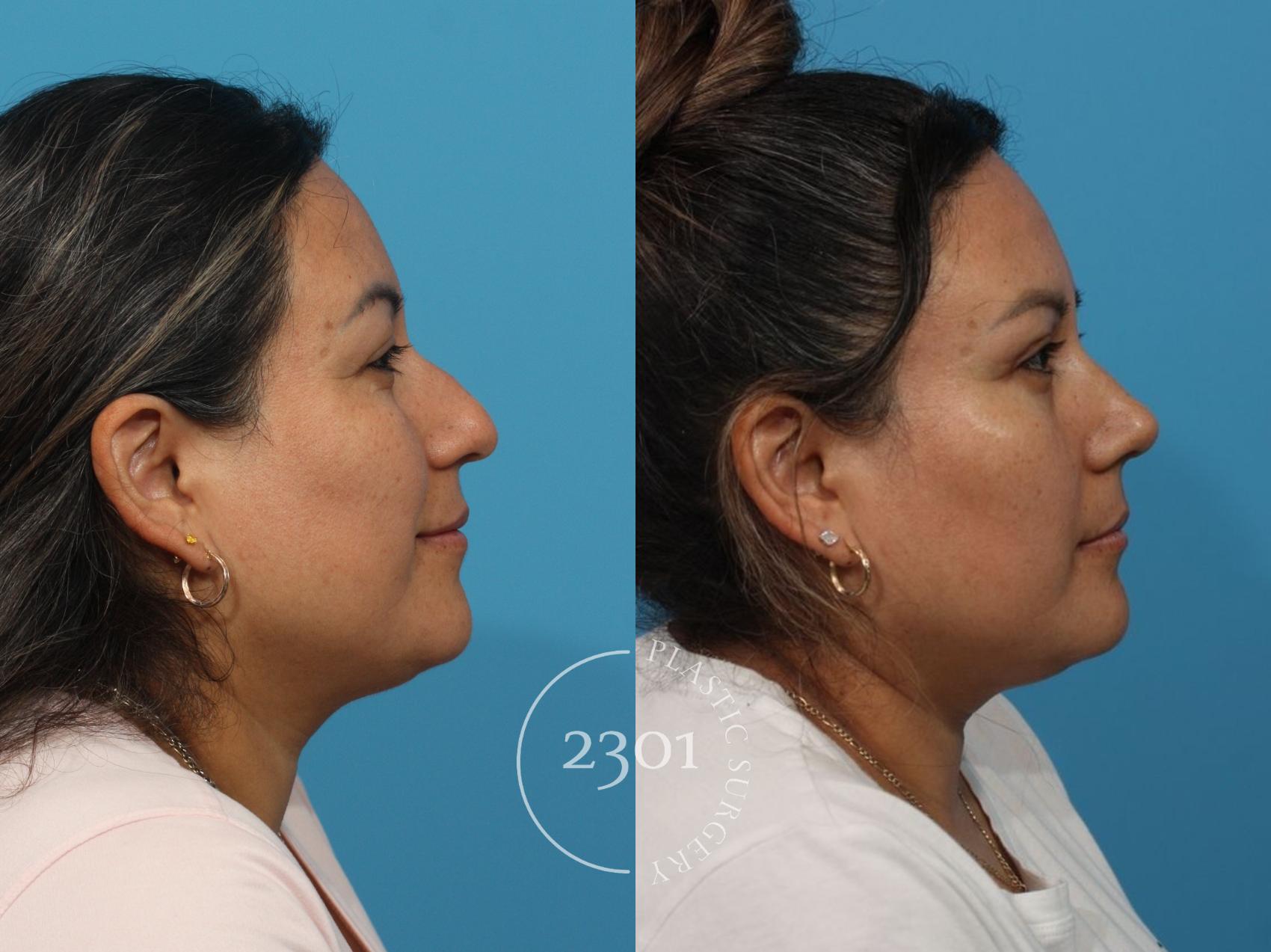 Before & After Rhinoplasty Case 829 Left Side View in Fort Worth, Plano, & Frisco, Texas