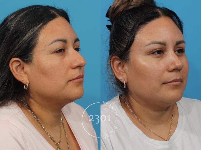 Before & After Rhinoplasty Case 829 Right Oblique View in Fort Worth, Plano, & Frisco, Texas