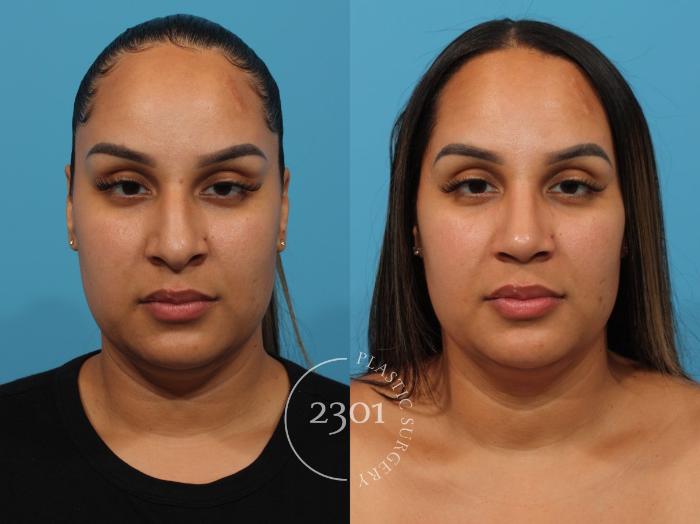 Before & After Rhinoplasty Case 831 Front View in Fort Worth, Plano, & Frisco, Texas