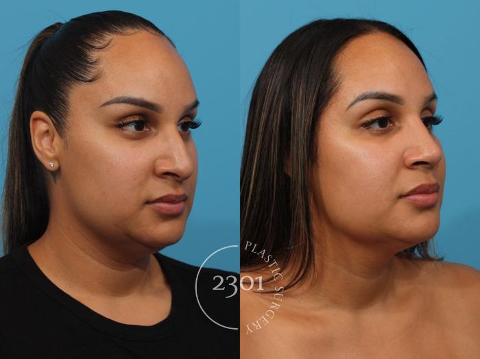 Before & After Rhinoplasty Case 831 Right Oblique View in Fort Worth, Plano, & Frisco, Texas