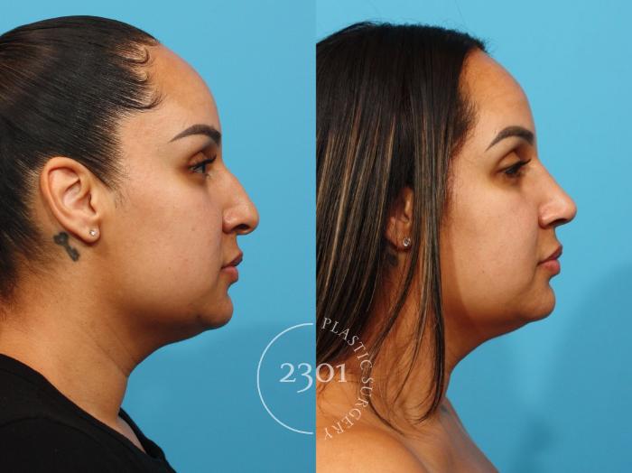 Before & After Rhinoplasty Case 831 Right Side View in Fort Worth, Plano, & Frisco, Texas