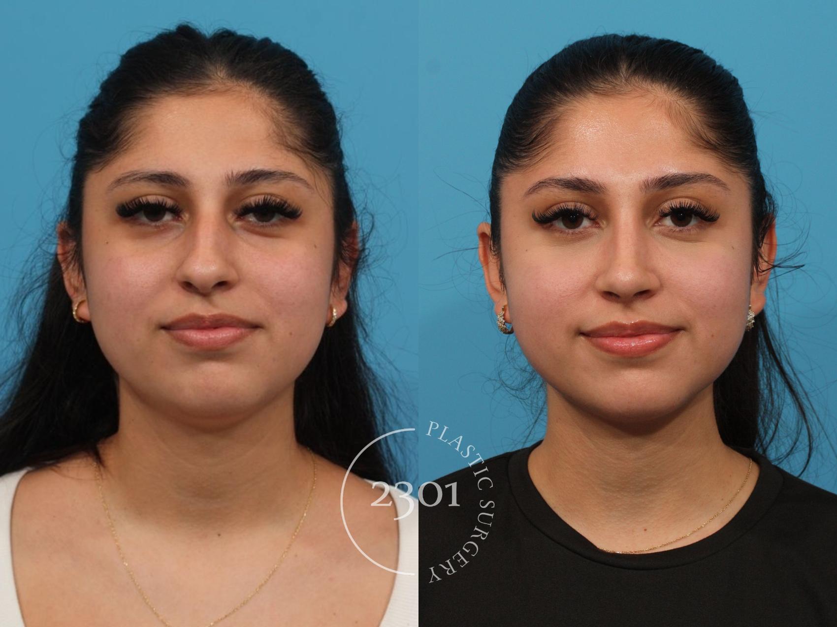 Before & After Rhinoplasty Case 832 Front View in Fort Worth, Plano, & Frisco, Texas