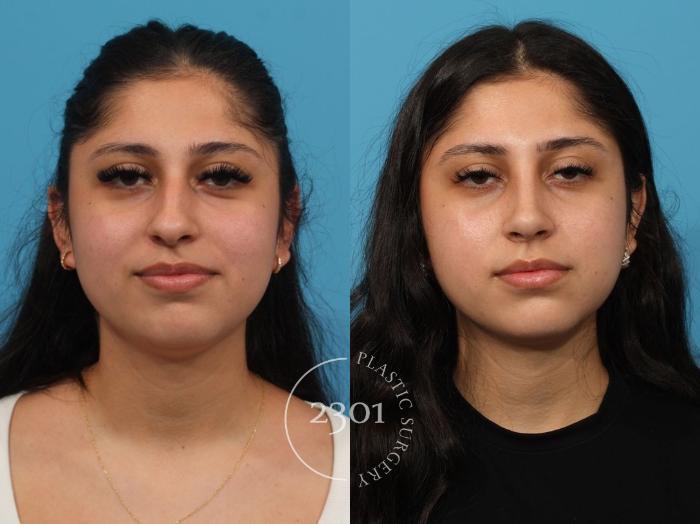 Before & After Rhinoplasty Case 832 Front View in Fort Worth, Plano, & Frisco, Texas