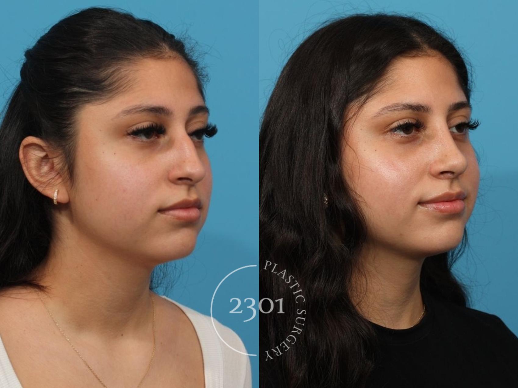 Before & After Rhinoplasty Case 832 Right Oblique View in Fort Worth, Plano, & Frisco, Texas