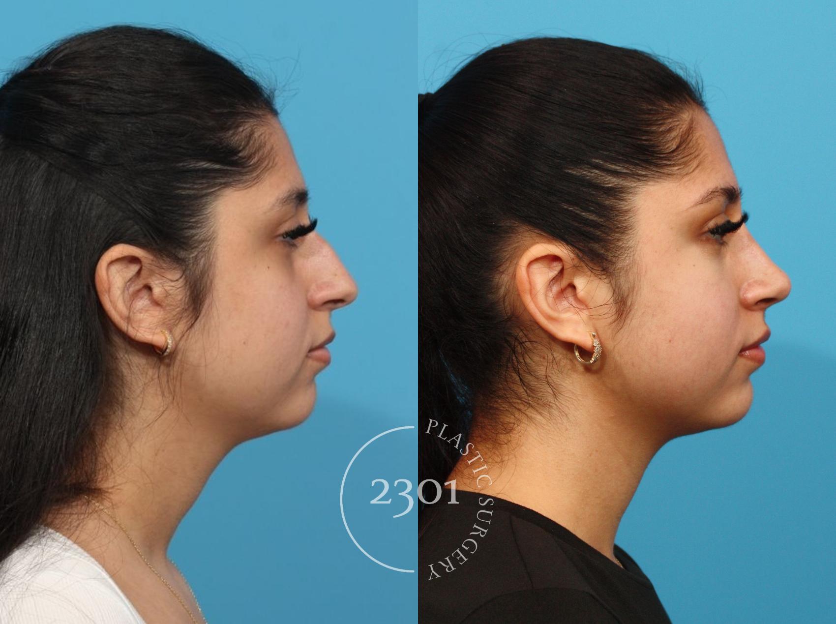 Before & After Rhinoplasty Case 832 Right Side View in Fort Worth, Plano, & Frisco, Texas