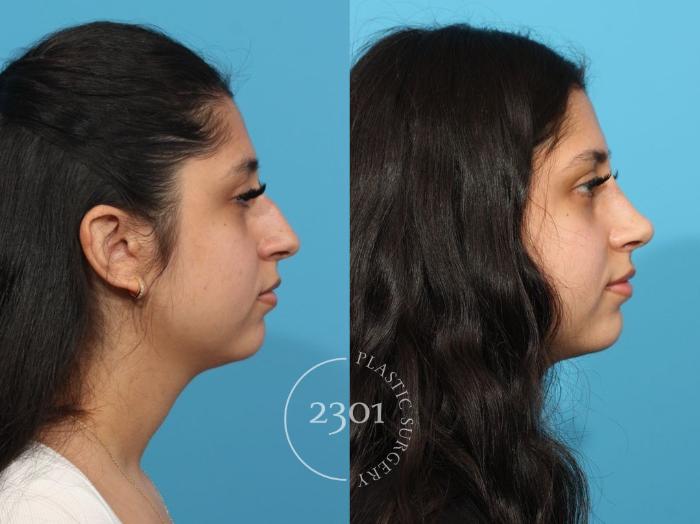 Before & After Rhinoplasty Case 832 Right Side View in Fort Worth, Plano, & Frisco, Texas