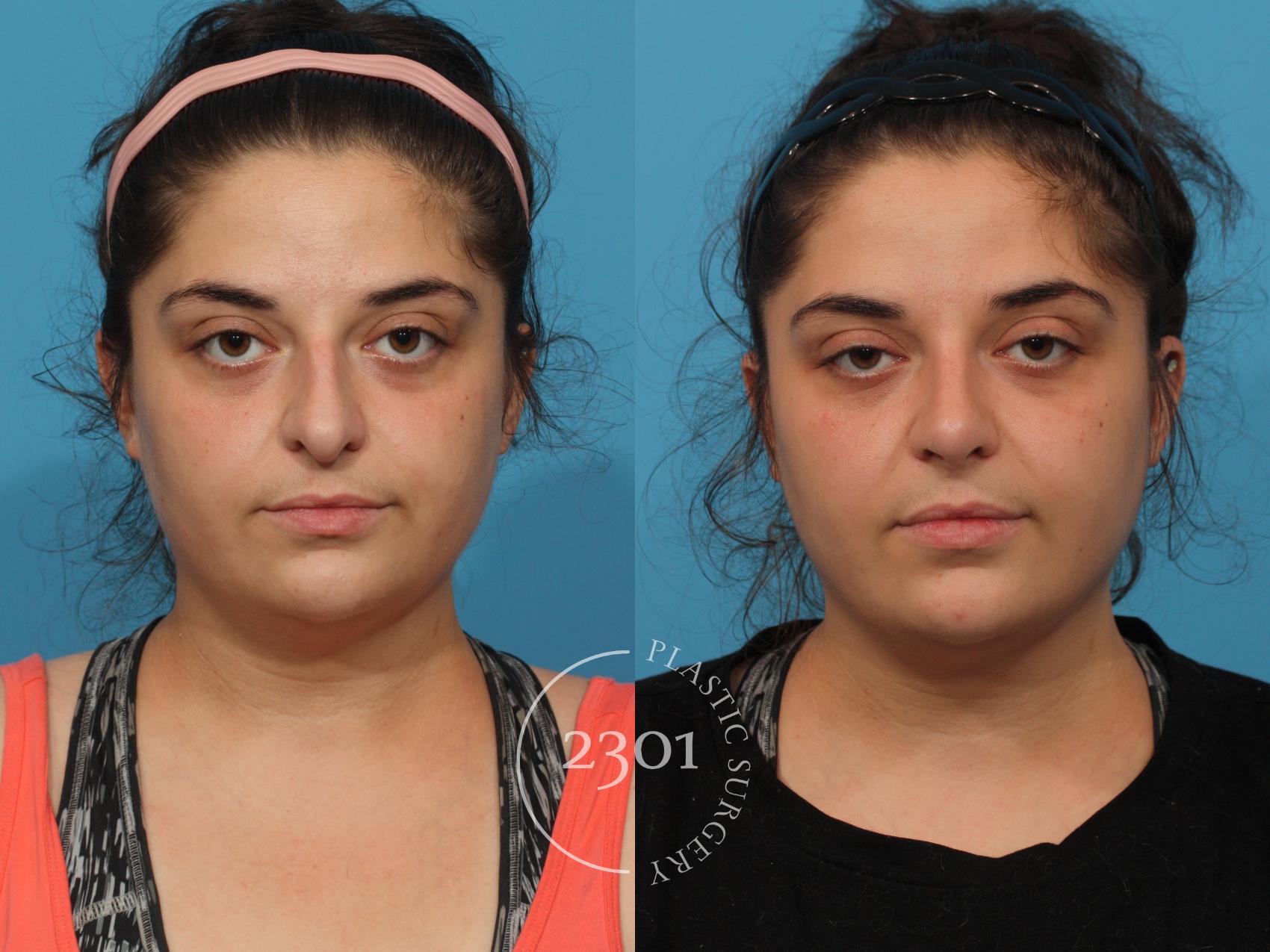 Before & After Rhinoplasty Case 837 Front View in Fort Worth, Plano, & Frisco, Texas