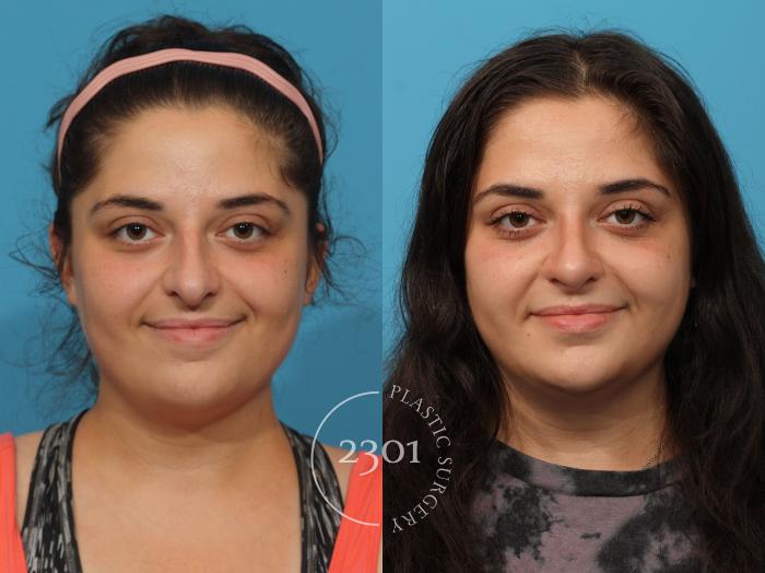 Before & After Rhinoplasty Case 837 Front View in Fort Worth, Plano, & Frisco, Texas